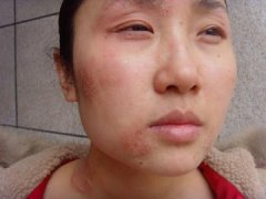 皮炎怎么引起的，太原治疗皮炎好一点的医院