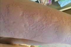 [晋中皮肤过敏医院]常见皮肤过敏的危害