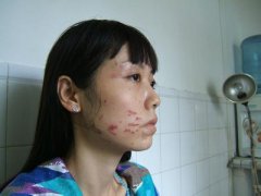 [阳泉皮炎医院]脂溢性皮炎发病原因是什么？