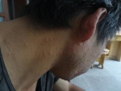 [忻州过敏医院]如何判断自己是不是过敏了