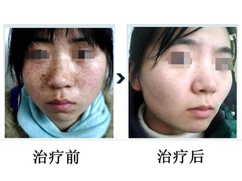 九州治疗雀斑后,还需要哪些皮肤保养方法?